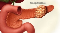 دانستنیهای ضروری در مورد سرطان لوزالمعده (پانکراس)