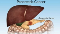 درمان سرطان پانکراس به کمک نانو ذرات حامل دارو